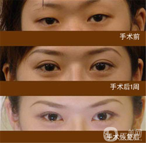 生物焊接雙眼皮多少錢？*果怎么樣？