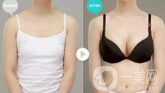 妙桃假體豐胸價(jià)格