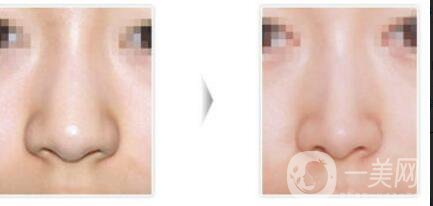 鼻翼縮小整形價(jià)格,鼻翼縮小術(shù)后護(hù)理
