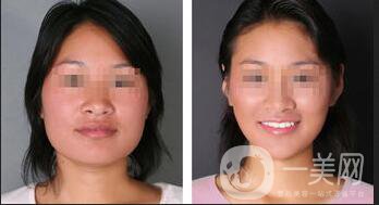 下頜角截骨,下頜角截骨術(shù)后護理方式