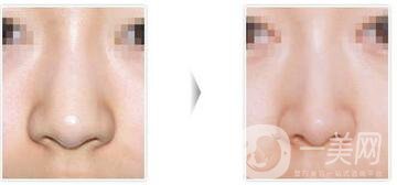 縮小鼻翼整形手術(shù)費(fèi)用,縮小鼻翼*果