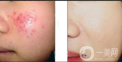 果酸換膚多少錢(qián),果酸換膚注意事項(xiàng)