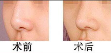 駝峰鼻矯正價(jià)錢一般是多少錢