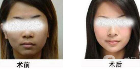 黑臉娃娃縮小毛孔多少錢？