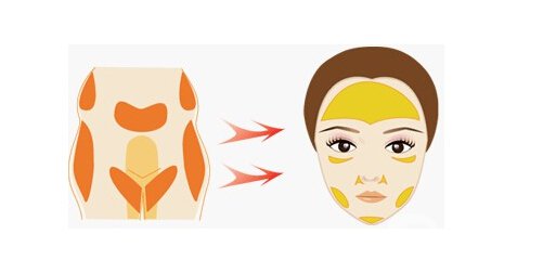 自體脂肪填充疼嗎 自體脂肪填充怎樣