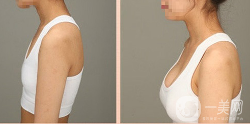 假體豐胸術(shù)后痛多久能恢復(fù)正常 怎么護(hù)理