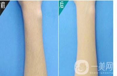 手臂激光脫毛價格 激光脫毛*果如何