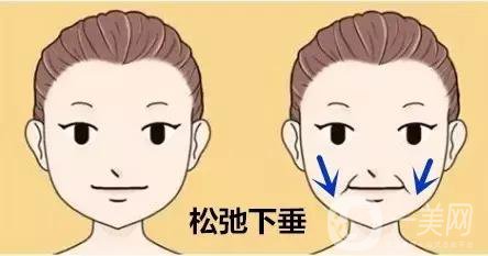 玻尿酸去法令紋的價格 去法令紋的方法