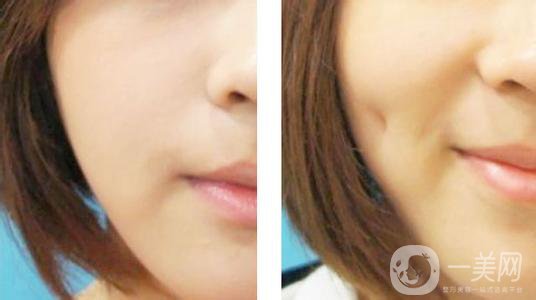 酒窩成形術(shù)的價(jià)格 酒窩做什么手術(shù)