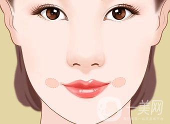 酒窩成形術(shù)的價(jià)格 酒窩做什么手術(shù)