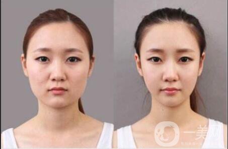 打*一針多少錢(qián) 打*注意事項(xiàng)