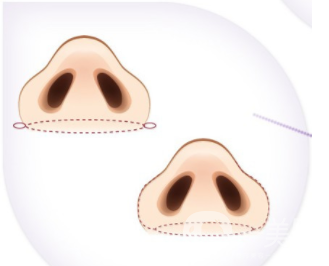 鼻翼縮小整形價格,鼻翼縮手術(shù)注意事項