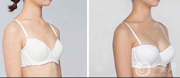 抽脂隆胸整形手術(shù)價(jià)格,自體脂肪隆胸注意事項(xiàng)