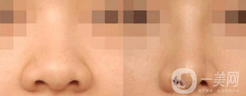 鼻翼縮小價(jià)位,鼻翼縮小術(shù)后護(hù)理