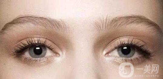 歐式雙眼皮貴嗎,歐式雙眼皮價格