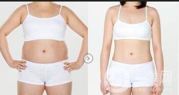 水動力吸脂方法,水動力吸脂*果