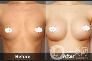 娜綺麗隆胸多少錢,隆胸注意事項