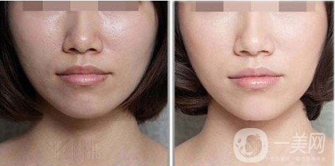 鐳射激光嫩膚是什么 主要有哪些作用？