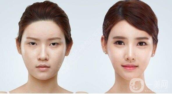 玻尿酸隆鼻價位 玻尿酸隆鼻注意事項