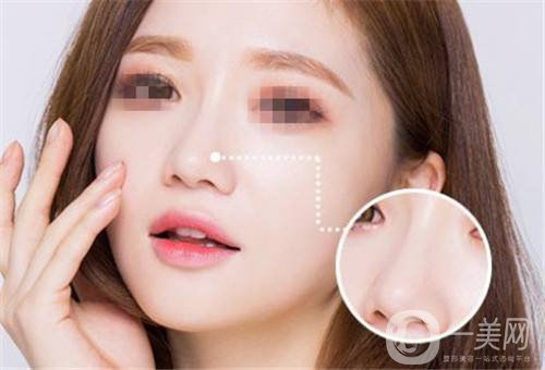 玻尿酸隆鼻手術(shù)需要多少錢 *果怎么樣？