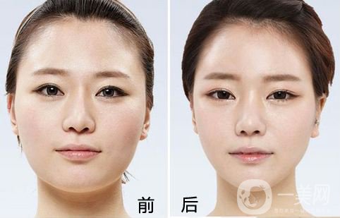 自體脂肪墊下巴多少錢 自體脂肪墊下巴注意事項