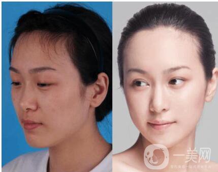 隆鼻整形費(fèi)用多少錢 隆鼻手術(shù)方法