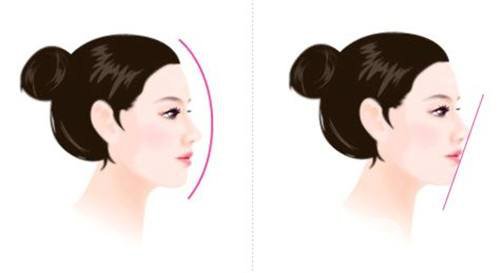 假體隆鼻手術(shù)需要多少錢(qián) 什么是妙桃假體填充