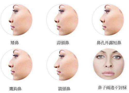 玻尿酸隆鼻大概需要多少錢 注射玻尿酸的方法