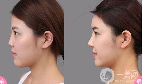 自體隆鼻價(jià)格是多少 *果好不好？