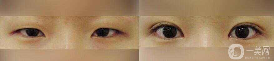 開眼角有危險(xiǎn)嗎 開眼角多少錢