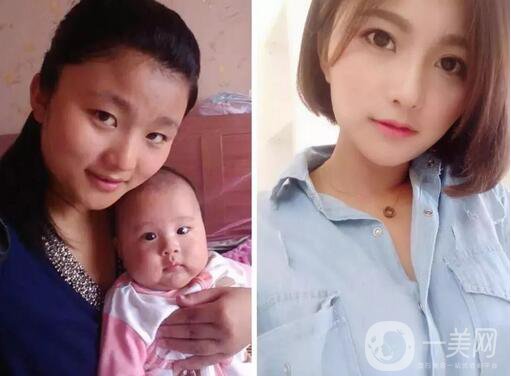 整容對人生的改變真的大嗎 整容后的人生變好了嗎