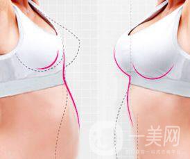 自體脂肪豐胸,自體脂肪豐胸術(shù)后護理