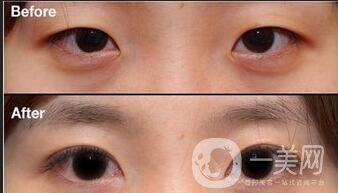 三點定位雙眼皮,全切,埋線