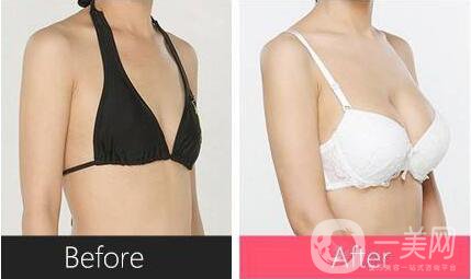 假體隆胸取出整形手術(shù)價(jià)格 假體隆胸的手術(shù)方式