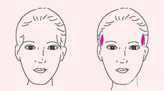 玻尿酸豐太陽(yáng)穴報(bào)價(jià) 玻尿酸豐太陽(yáng)穴的方法