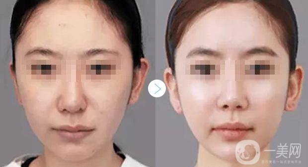 *注射適宜人群有哪些 *果怎么樣？