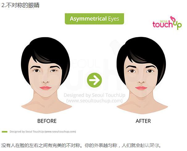 韓國(guó)做雙眼皮手術(shù)常見的5個(gè)問題解答