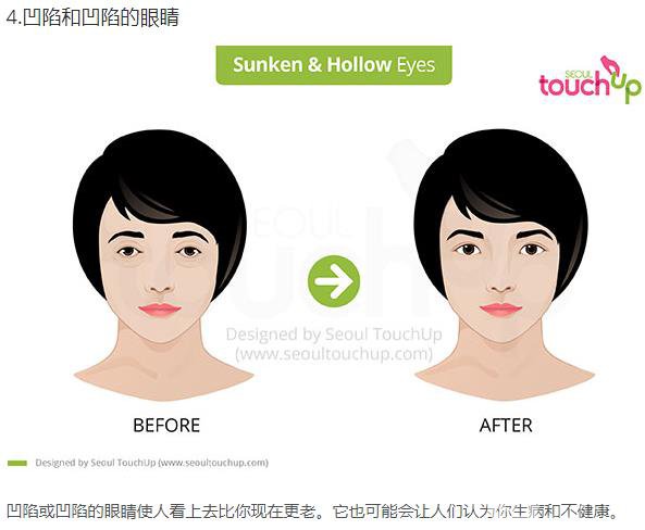 韓國(guó)做雙眼皮手術(shù)常見的5個(gè)問題解答