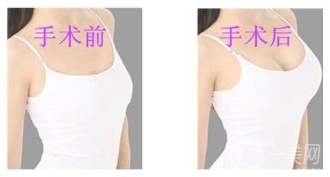 假體隆胸的恢復(fù)時間是多久？