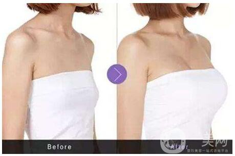 隆胸選擇哪種材料*好？隆胸醫(yī)生教你選擇！