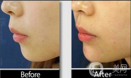 下巴注射玻尿酸,注射玻尿酸術(shù)后注意事項(xiàng)
