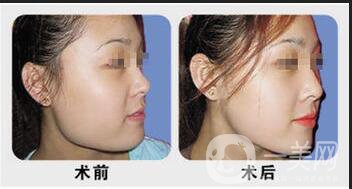 下頜角磨骨整形價格,下頜角磨骨多少錢