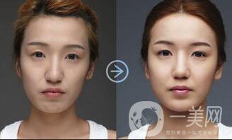 面部脂肪填充價(jià)格,面部脂肪填充貴不貴