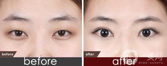 全切雙眼皮,全切雙眼皮需要拆線嗎,全切雙眼皮術(shù)后注意事項