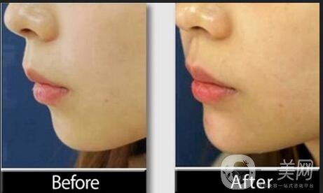 玻尿酸墊下巴注意事項