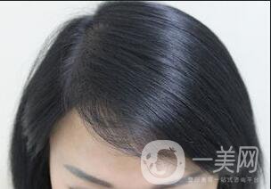 發(fā)際線種植恢復期