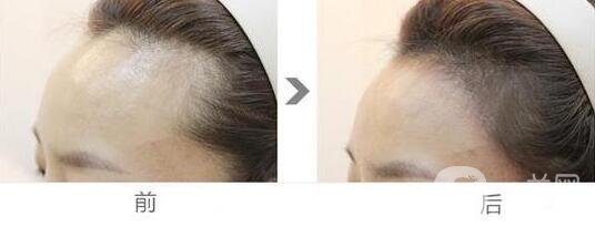 發(fā)際線種植恢復期