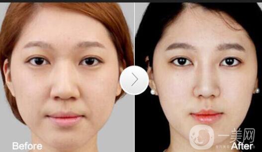 鼻翼縮小多少錢,鼻翼縮小術(shù)后護理