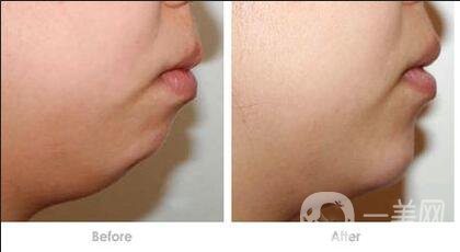 下巴吸脂多久恢復(fù),下巴吸脂術(shù)后護理方式