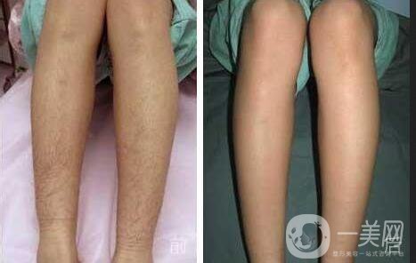 大腿激光脫毛價(jià)格